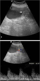Fallopian tube cancer and primary peritoneal cancer). Sonographic And Doppler Predictors Of Malignancy In Ovarian Lesions Egyptian Journal Of Radiology And Nuclear Medicine Full Text