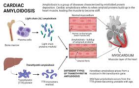 comprehensive amyloidosis program