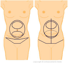 How Tummy Tuck (Abdominoplasty) Surgery Is Performed |TuckThatTummy.com