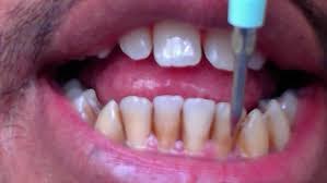 There are treatments patients can do at home, or in our office to remove those annoying coffee stains. How To Remove Brown Stains On Teeth Comfortably At Home Teeth Mastery