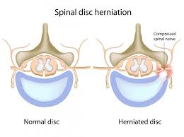 spinal disc herniation homeopathic