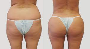 Do you have to gain weight for bbl? Brazilian Butt Lift Houston Dr Nikko Cosmetic Surgery Center