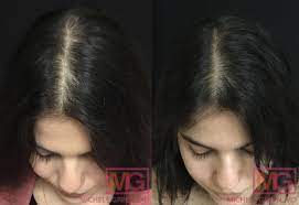postpartum hair loss pregnancy hair