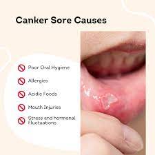 homeopathy for canker sores causes