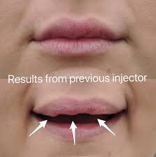 lip filler correction case study