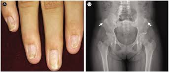 patient with nail patella syndrome