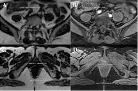 mri biomarker of muscle composition is