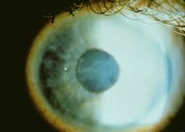 Anterior basement membrane corneal dystrophy. Treatment Of Epithelial Basement Membrane Dystrophy With Manual Superficial Keratectomy Eyerounds Org Ophthalmology The University Of Iowa