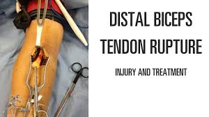 distal biceps tendon rupture symptoms