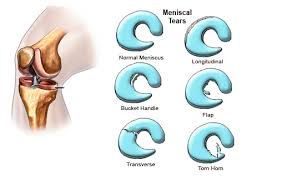 meniscus tear in knee signs symptoms