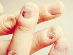 nail fungal infection causes