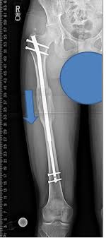 limb lengthening an overview by s