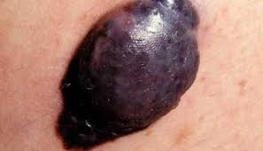 It is essential that new, changing or unusual moles and spots are checked to exclude malignant melanoma. Nodular Melanoma Symptoms Risk Factors Diagnosis And Treatment