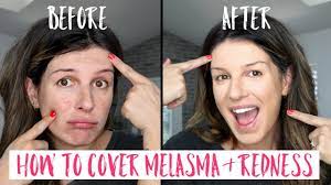 how to cover melasma and redness