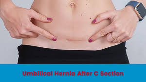 umbilical hernia after c section