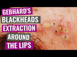 blackheads extraction around the lips