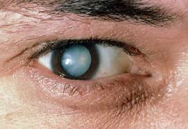 cataracts symptoms causes surgery