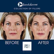 how long does juvederm take to set in