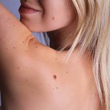 what is seborrheic keratosis and how is