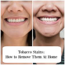 The best way to get rid of coffee stains on your teeth is to start with a good cleaning at your dentist's office. Pin On Science Of Teeth Whitening
