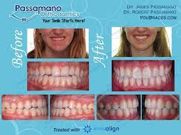 When it comes time to install the braces, small square brackets are bonded to the front of each tooth. Pin On Invisalign Smile Transformations