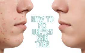 how to fix uneven skin tone