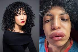 allergic reaction was triggered by a kiss