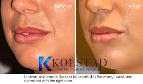 lip filler with restylane before