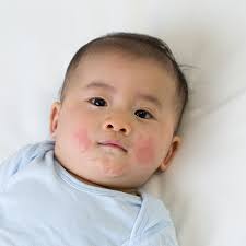 rashes in kids age by age skin