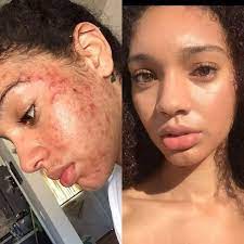 s completely natural acne cure is