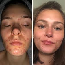 B & A : Acne that takes a little longer to heal – Supple Skin Co
