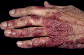 It happens whenever blood vessels in the hand become dilated. Differential Diagnoses Conditions Of The Hands Gponline