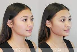 the importance of jawline contouring