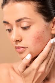 wear makeup on accutane for acne