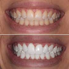 is professional teeth whitening safe