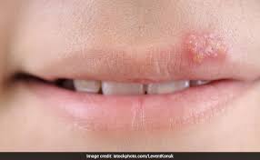 6 tips to treat herpes naturally and