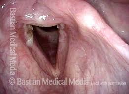 acid reflux in the throat