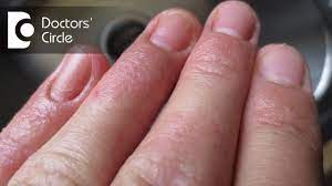 contact dermais on fingertips
