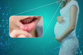 mouth ulcers in pregnancy