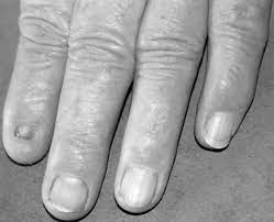 nail patella syndrome a review of the