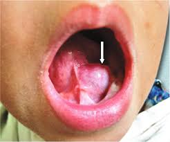 swellings of the tongue springerlink