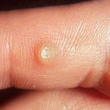 5 types of warts to know knoxville