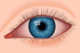 dry eye syndrome causes symptoms and
