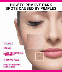how to remove dark spots caused by pimples