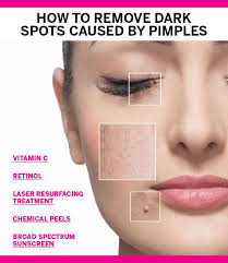 remove dark spots caused by pimples