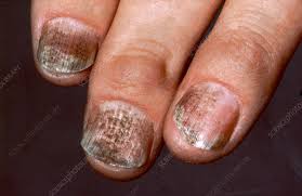 psoriatic arthritis fingers stock