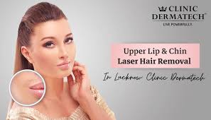 upper lip chin laser hair removal in