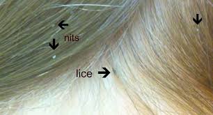Image result for head lice