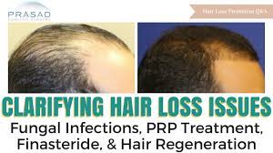Approaches to complex therapy of women's diffusive alopecia with homeopathic preparation and special cosmetic substances. Hair Loss Issues Fungal Infections And Options When Prp And Finasteride Don T Work For You Youtube