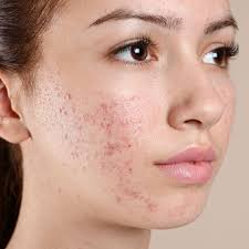 acne scarring pigmentation